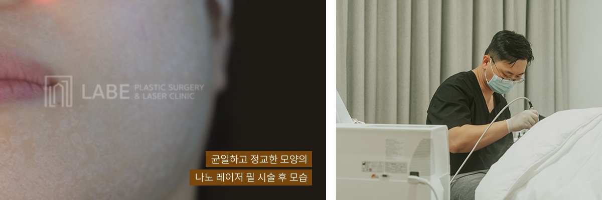 균일하고 정교한 모양의 나노 레이저 필 시술 후 모습
